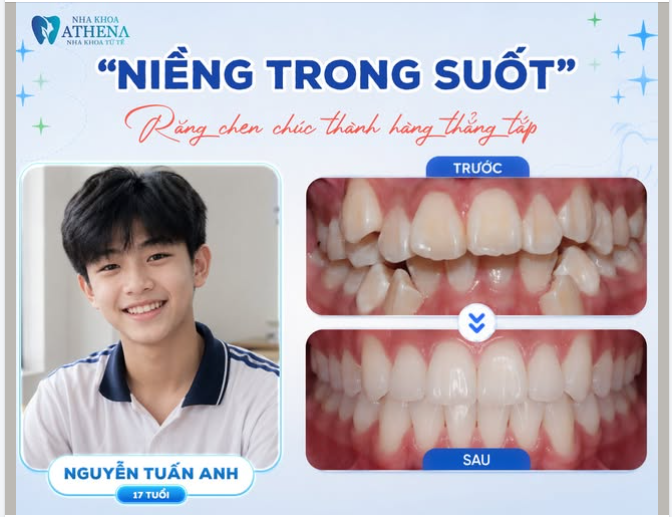 NIỀNG TRONG SUỐT – RĂNG CHEN CHÚC THÀNH HÀNG THẲNG TẮP CÙNG TUẤN ANH (17 TUỔI)