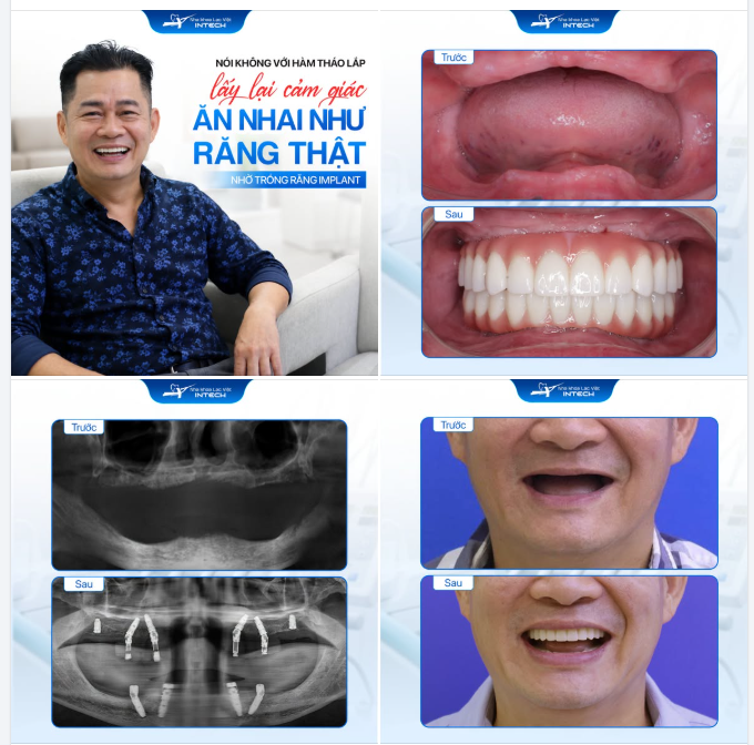 TỪ CHỐI HÀM THÁO LẮP, ĂN NHAI NHƯ RĂNG THẬT NHỜ TRỒNG RĂNG IMPLANT