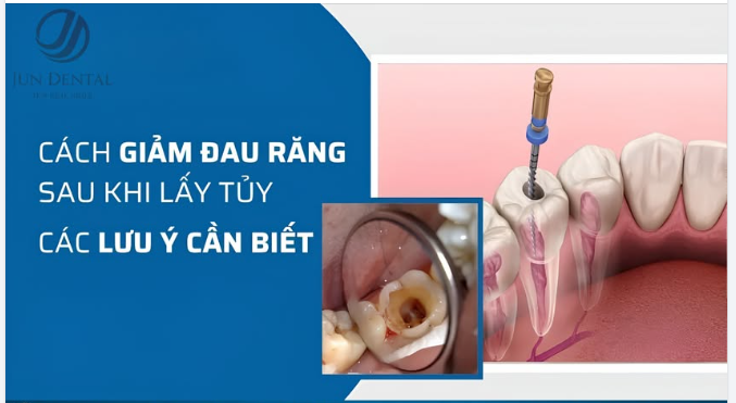 Sau khi lấy tủy răng có đau không? Làm sao để giảm đau hiệu quả?