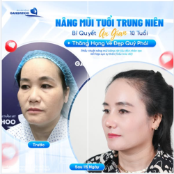 NÂNG MŨI Ở TUỔI TRUNG NIÊN