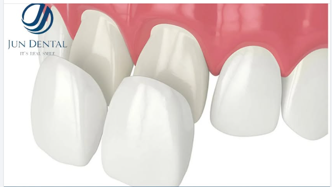 DÁN SỨ VENEER – NỤ CƯỜI ĐẸP TỰ NHIÊN, TINH TẾ
