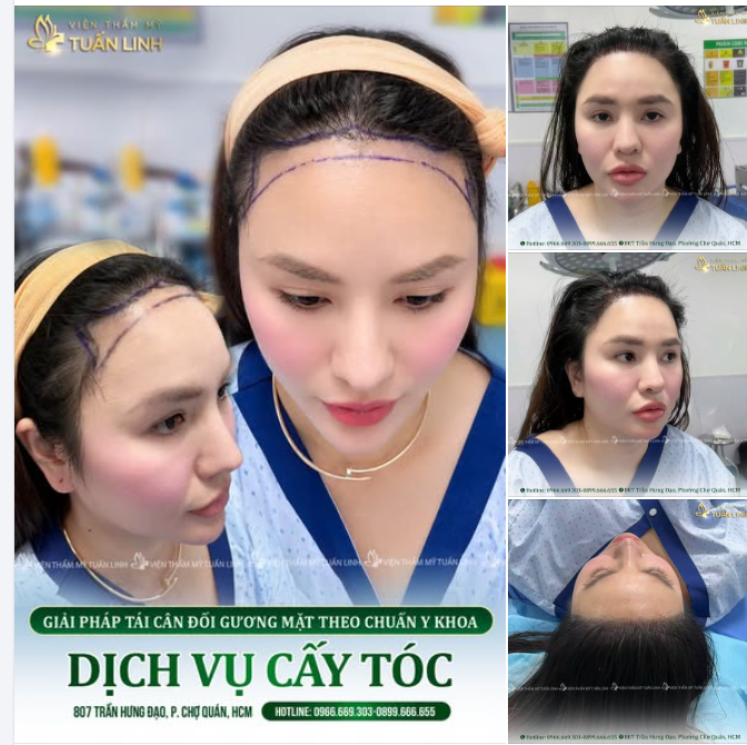 CẤY TÓC THƯỢNG HẢI - GIẢI PHÁP TÁI CÂN ĐỐI GƯƠNG MẶT CHUẨN Y KHOA