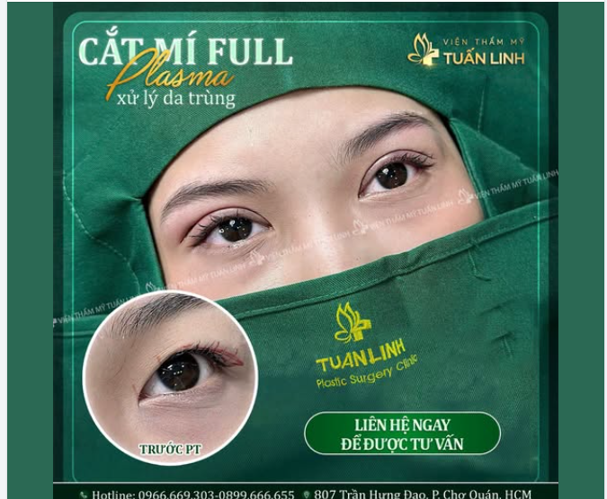 CẮT MÍ – “NÂNG CẤP” ĐÔI MẮT, NÂNG TẦM THẦN THÁI