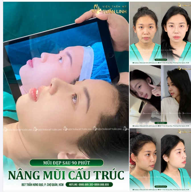 NÂNG MŨI CẤU TRÚC - ĐẸP TỨC THÌ, BỀN DÀI LÂU