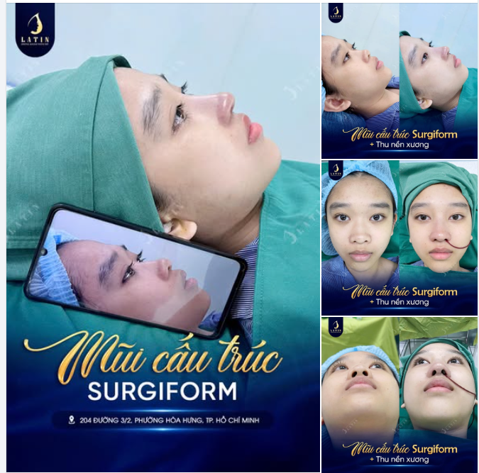 MŨI CẤU TRÚC SURGIFORM + THU NỀN X.ƯƠNG: ĐẸP KHÔNG PHẢI LÀ CÀNG CAO CÀNG TỐT