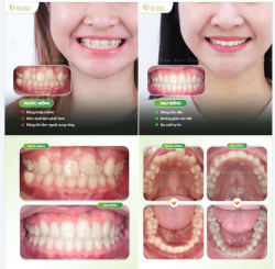 NIỀNG RĂNG KHẤP KHỂNH LẤY LẠI TỰ TIN