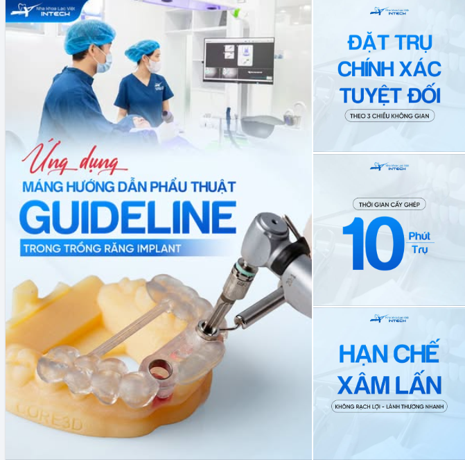 MÁNG HƯỚNG DẪN PHẪU THUẬT GUIDELINE - "BẢN ĐỒ DẪN ĐƯỜNG" CHO MỘT CA IMPLANT THÀNH CÔNG