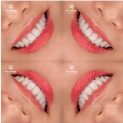 Đừng ngần ngại yêu thương nụ cười của mình theo cách dịu dàng nhất. Nếu bạn đang tìm kiếm một sự thay đổi mà không phải đánh đổi, hãy để Win Smile lắng nghe câu chuyện của bạn nhé!