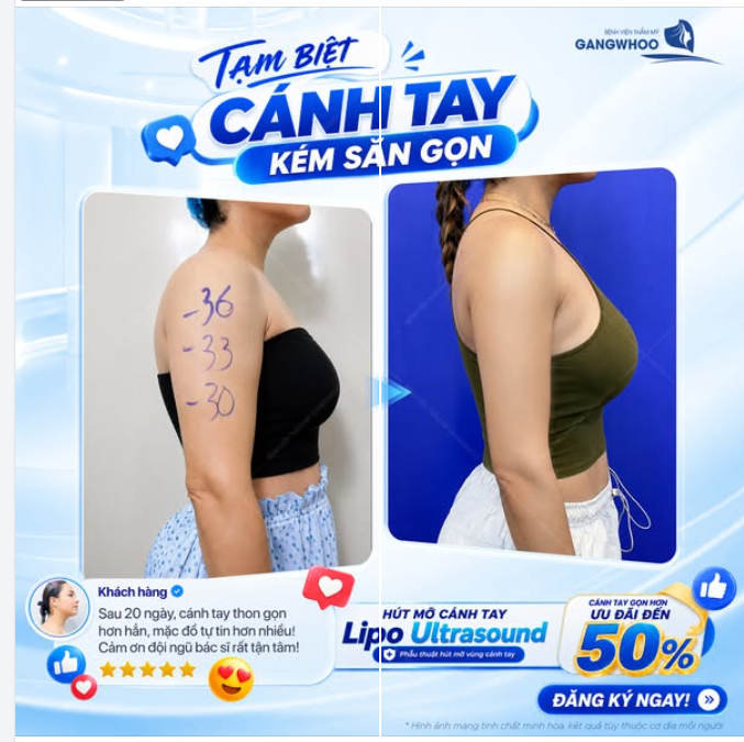TẠM BIỆT CÁNH TAY KÉM SĂN GỌN
