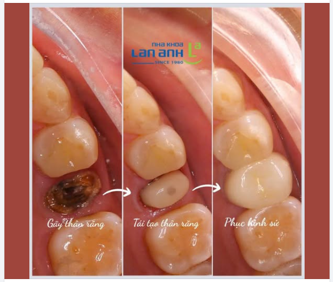 3-5 NGÀY CHO MỘT CHIẾC RĂNG GÃY ĐƯỢC PHỤC HỒI