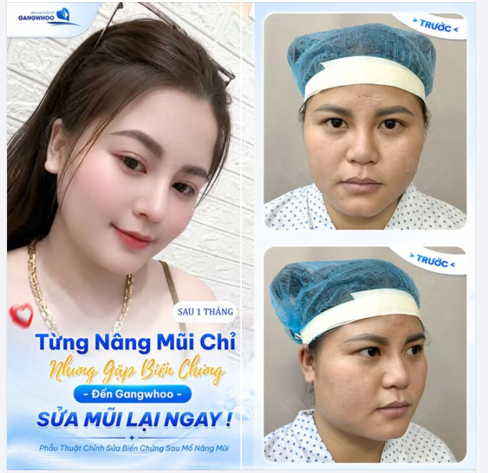 TỪNG NÂNG MŨI CHỈ NHƯNG GẶP BIẾN CHỨNG