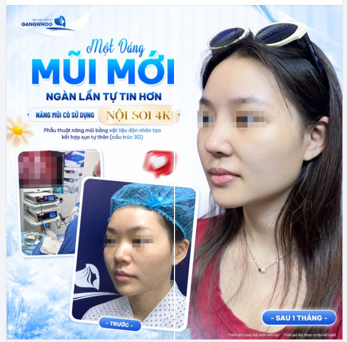 MỘT DÁNG MŨI MỚI - NGÀN LẦN TỰ TIN HƠN