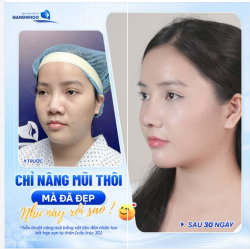 CHỈ NÂNG MŨI THÔI MÀ ĐÃ ĐẸP NHƯ NÀY RỒI SAO?