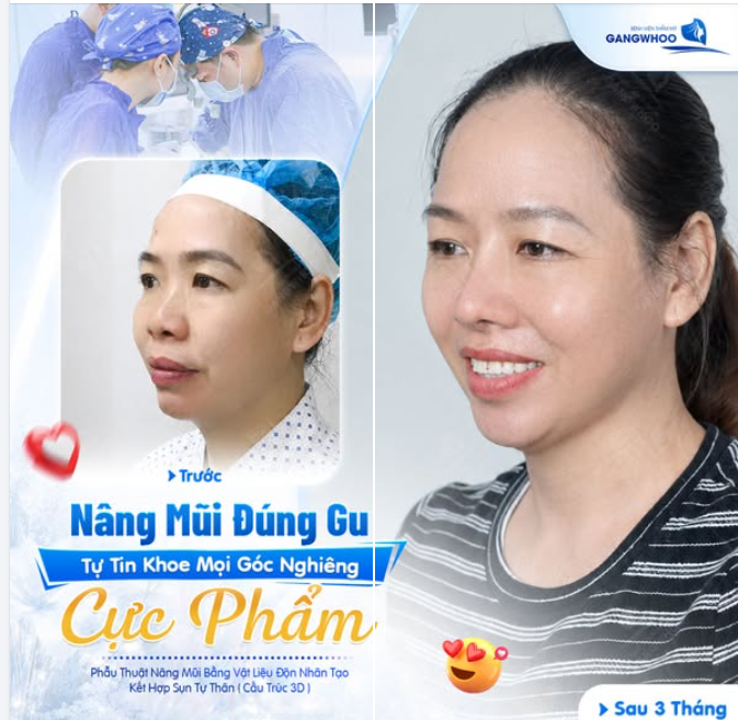 NÂNG MŨI ĐÚNG GU - TỰ TIN KHOE GÓC NGHIÊNG CỰC PHẨM