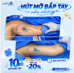 CẢI THIỆN ĐƯỜNG NÉT VÙNG BẮP TAY NHẸ NHÀNG