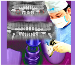 Hướng dẫn chăm sóc răng sau cấy implant