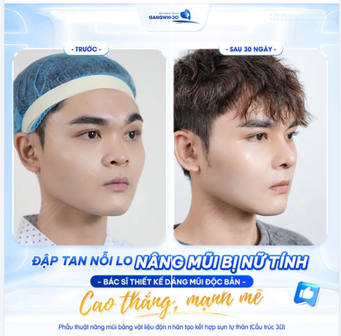 BÁC SĨ THIẾT KẾ DÁNG MŨI ĐỘC BẢN: CAO THẲNG - MẠNH MẼ