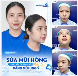 KẾT QUẢ SAU 1 THÁNG MŨI HỎNG SỬA LẠI