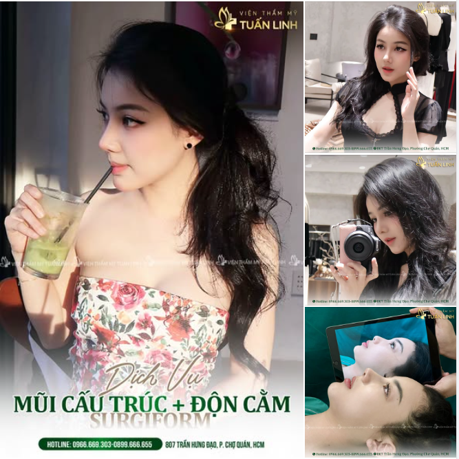 NÂNG MŨI + ĐỘN CẰM – CÔNG THỨC VÀNG TẠO GÓC NGHIÊNG HOÀN HẢO!!