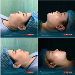 HÚT MỠ NỌNG HÀM – THAY ĐỔI NHẸ NHÀNG NHƯNG GƯƠNG MẶT NHÌN GỌN HƠN HẲN