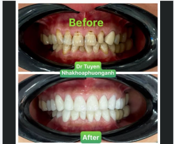 Đối tượng nào nên bọc răng sứ ?