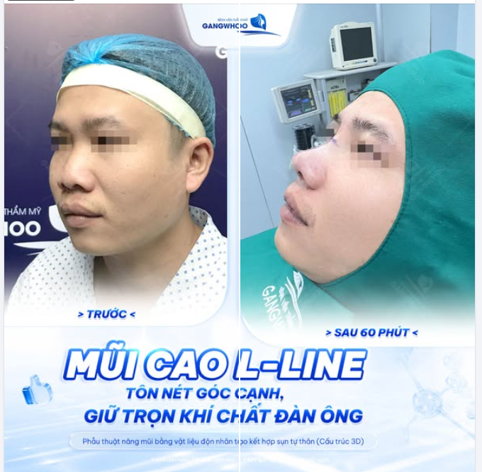 60 PHÚT TAAIJ CHIẾC MŨI CAO DÁNG L-LINE