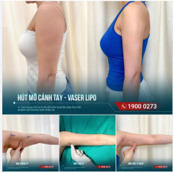 CÁNH TAY THAY ĐỔI RA SAO SAU HÚT MỠ?