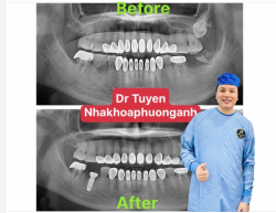 Các bước chuẩn bị trước khi cấy ghép Implant