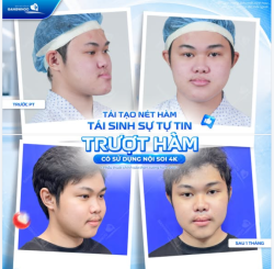 TÁI TẠO NÉT HÀM, TÁI SINH SỰ TỰ TIN - TRƯỢT HÀM CÓ SỬ DỤNG NỘI SOI 4K
