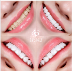 RĂNG SỨ VIET SMILE: TINH TẾ TRONG TỪNG ĐƯỜNG NÉT