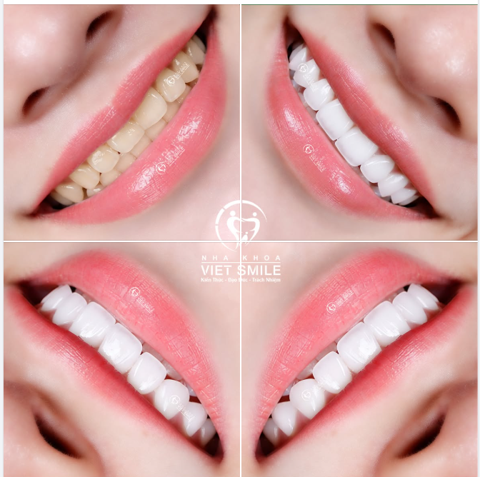 RĂNG SỨ VIET SMILE: TINH TẾ TRONG TỪNG ĐƯỜNG NÉT