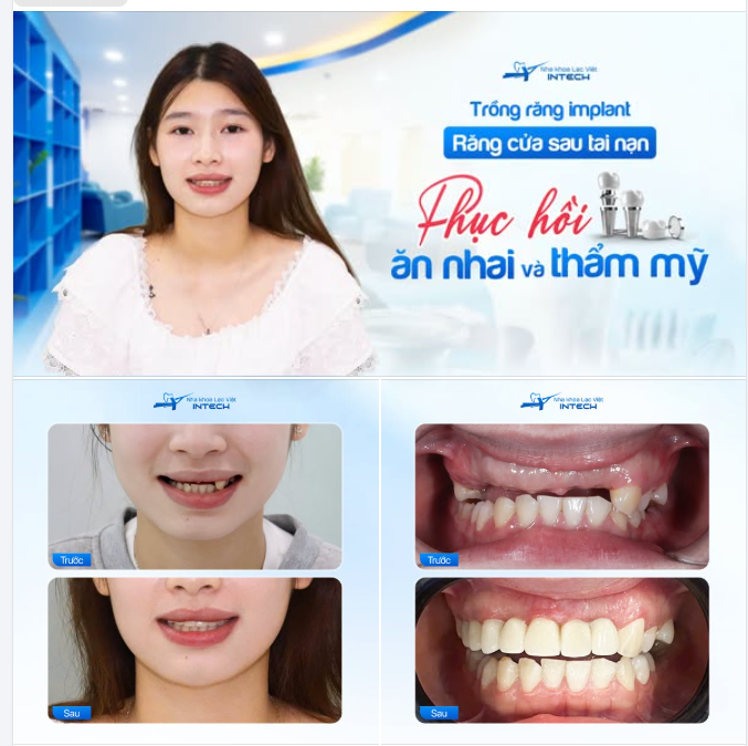 MẤT 8 RĂNG CỬA SAU TAI NẠN - TRỒNG RĂNG IMPLANT KHÔI PHỤC ĂN NHAI, TÁI TẠO NỤ CƯỜI CHO CÔ GÁI TRẺ
