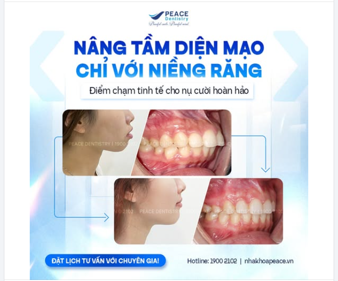 NIỀNG RĂNG CÓ THỂ THAY ĐỔI GÓC NGHIÊNG GƯƠNG MẶT NHƯ THẾ NÀO?