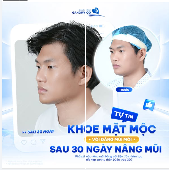 TỰ TIN KHOE MẶT MỘC VỚI DÁNG MŨI MỚI SAU 30 NGÀY NÂNG MŨI