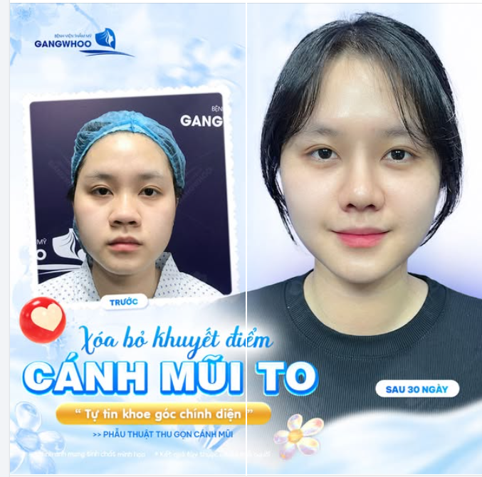 XÓA BỎ KHUYẾT ĐIỂM CÁNH MŨI TO