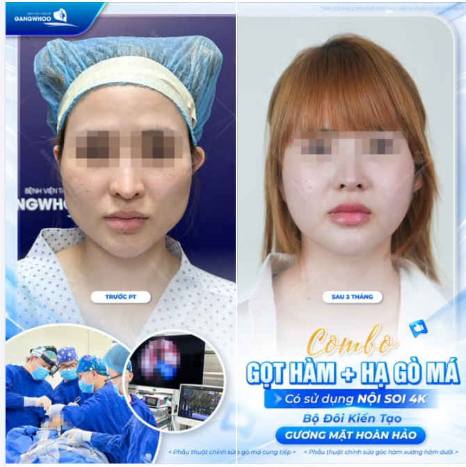 BỘ ĐÔI KIẾN TẠO GƯƠNG MẶT HÀI HÒA - COMBO GỌT HÀM + HẠ GÒ MÁ CÓ SỬ DỤNG NỘI SOI 4K