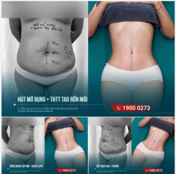 1 THÁNG SAU HÚT MỠ – ĐƯỜNG NÉT CƠ THỂ ĐÃ BẮT ĐẦU RÕ HƠN