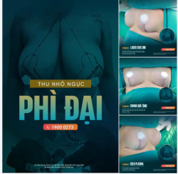 NGỰC QUÁ KHỔ KHÔNG CHỈ LÀ VẤN ĐỀ THẨM MỸ.