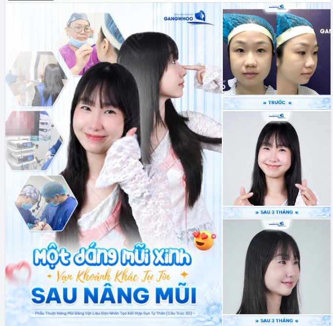 MỘT DÁNG MŨI XINH - NGÀN KHOẢNG KHẮC TỰ TIN