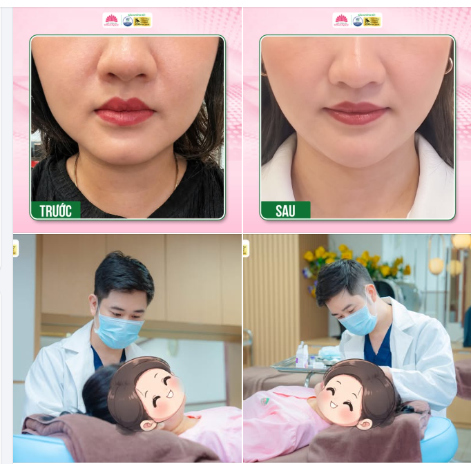 GÓC HÀM THÔ, BẠNH KHIẾN GƯƠNG MẶT KÉM THANH THOÁT?