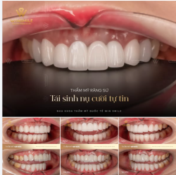 Sở hữu một công việc đòi hỏi sự chỉn chu và xuất hiện liên tục trước đám đông, nhưng chị Phượng lại luôn phải tiết chế cảm xúc vì bộ răng sứ cũ không ưng ý