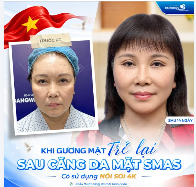 KHI GƯƠNG MẶT “TRẺ LẠI” SAU 1 LẦN THỰC HIỆN