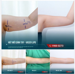 1 NĂM SAU HÚT MỠ CÁNH TAY — GIÁ TRỊ CỦA MỘT FEEDBACK NẰM Ở THỜI GIAN
