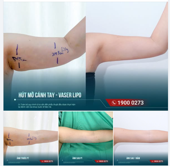 1 NĂM SAU HÚT MỠ CÁNH TAY — GIÁ TRỊ CỦA MỘT FEEDBACK NẰM Ở THỜI GIAN