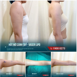 GỌN ĐƯỜNG NÉT CÁNH TAY – TRỌN ƯU ĐÃI THÁNG 8