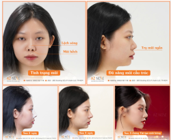 Mỗi ca mũi hỏng đều có nguyên nhân và mức độ khác nhau, vì vậy việc thăm khám trực tiếp để đưa ra chỉ định phù hợp là yếu tố quan trọng giúp tối ưu kết quả lâu dài.