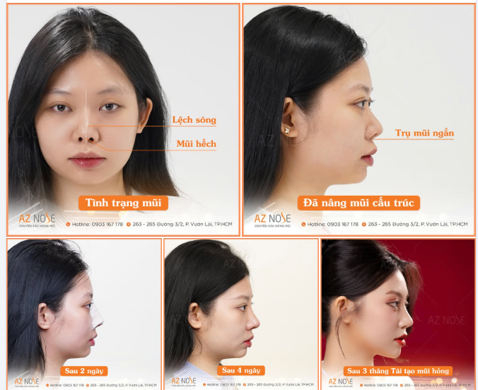 Mỗi ca mũi hỏng đều có nguyên nhân và mức độ khác nhau, vì vậy việc thăm khám trực tiếp để đưa ra chỉ định phù hợp là yếu tố quan trọng giúp tối ưu kết quả lâu dài.