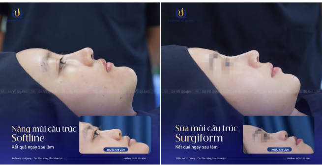 Những chiếc mũi sau nâng sẽ thay đổi một khuôn mặt như thế nào?