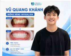 LỘT XÁC NỤ CƯỜI CHỈ SAU 1 NĂM – TỰ TIN RẠNG RỠ MỌI GÓC NHÌN!