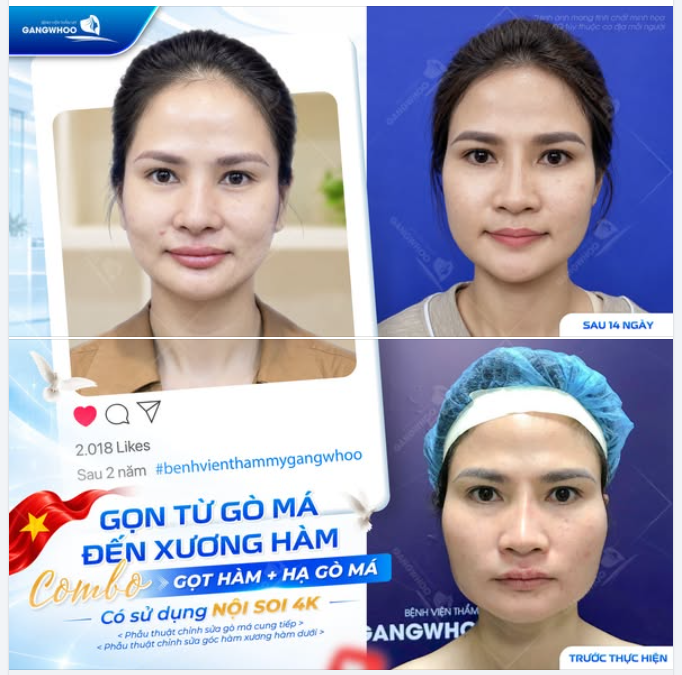 GỌN TỪ GÒ MÁ ĐẾN XƯƠNG HÀM - COMBO GỌT HÀM + HẠ GÒ MÁ CÓ SỬ DỤNG NỘI SOI 4K